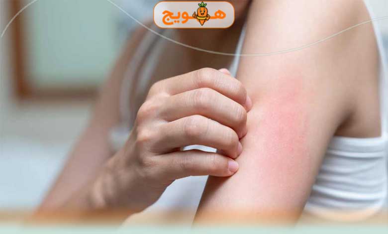 کبد چرب و خارش چه ارتباطی باهم دارند؟