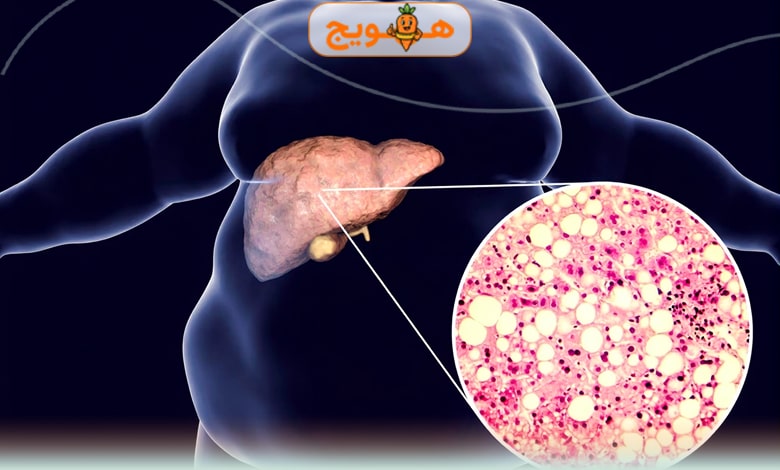 شکم بزرگ و کبد چرب