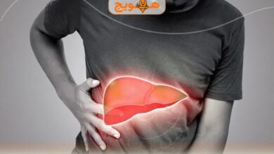 عوارض کبد چرب